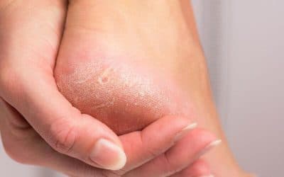 How Hyperkeratosis Can Affect Your Feet