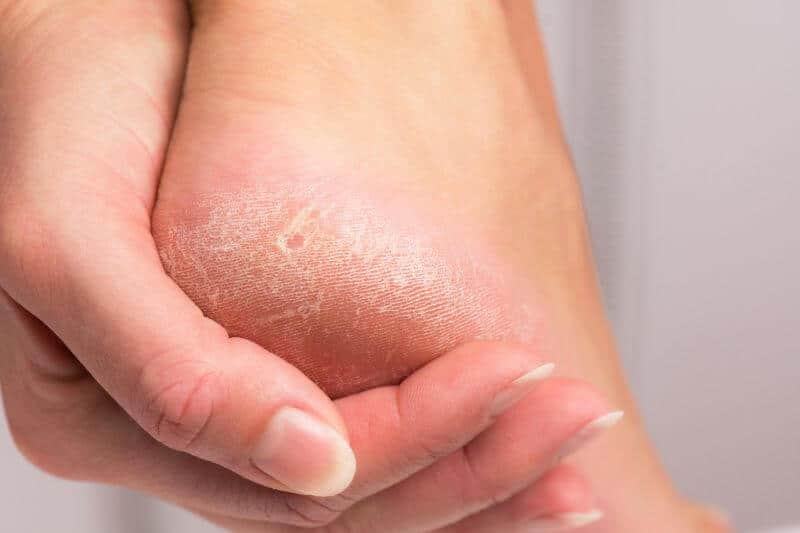 How to get Rid of Hard Skin on Feet