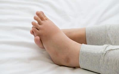 Why Do Your Feet and Ankles Swell?